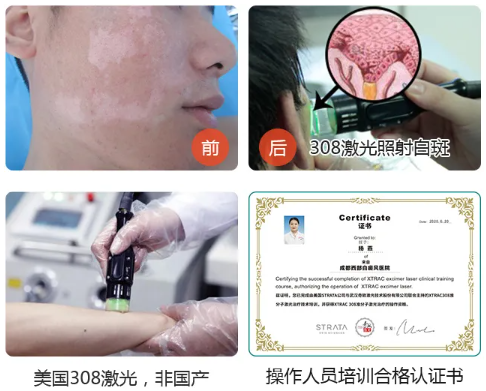 成都哪家医院治白癜风好