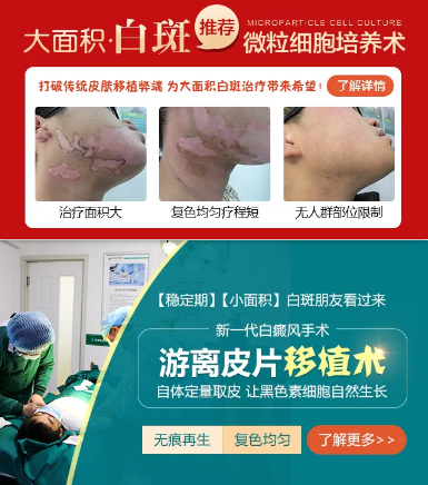 成都哪家医院治白癜风好