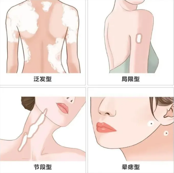 成都最好的白癜风医院是哪家